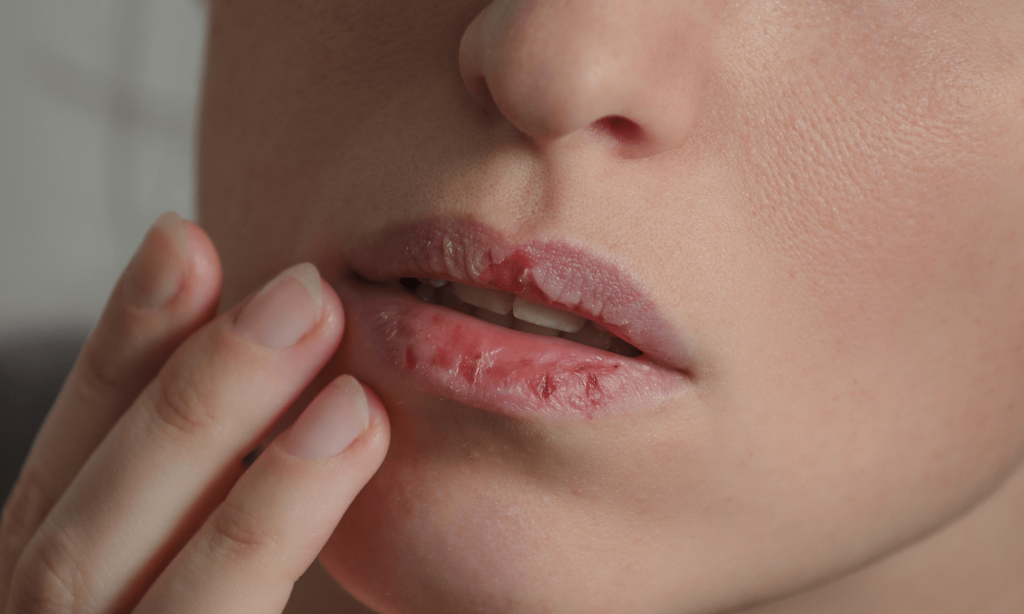 Et ansigt med ødelagte læber efter dermatillomani